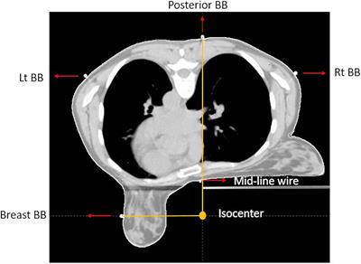 Accelerated partial breast irradiation in early stage breast cancer